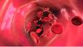 Video about peripheral arterial disease